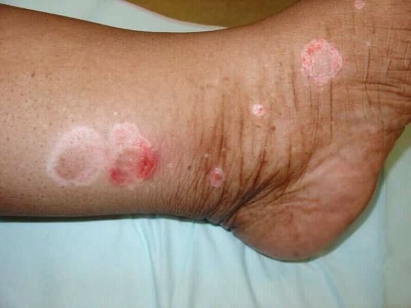Psoriasis plaques