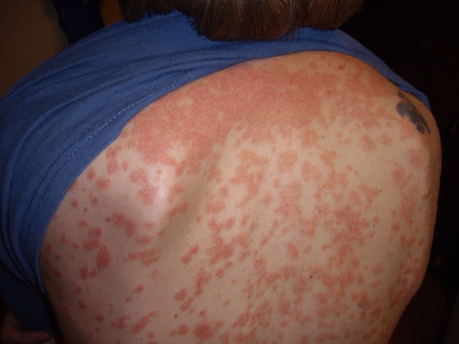 Guttate psoriasis on the back