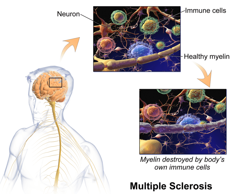 Biological effects of disease in neurons