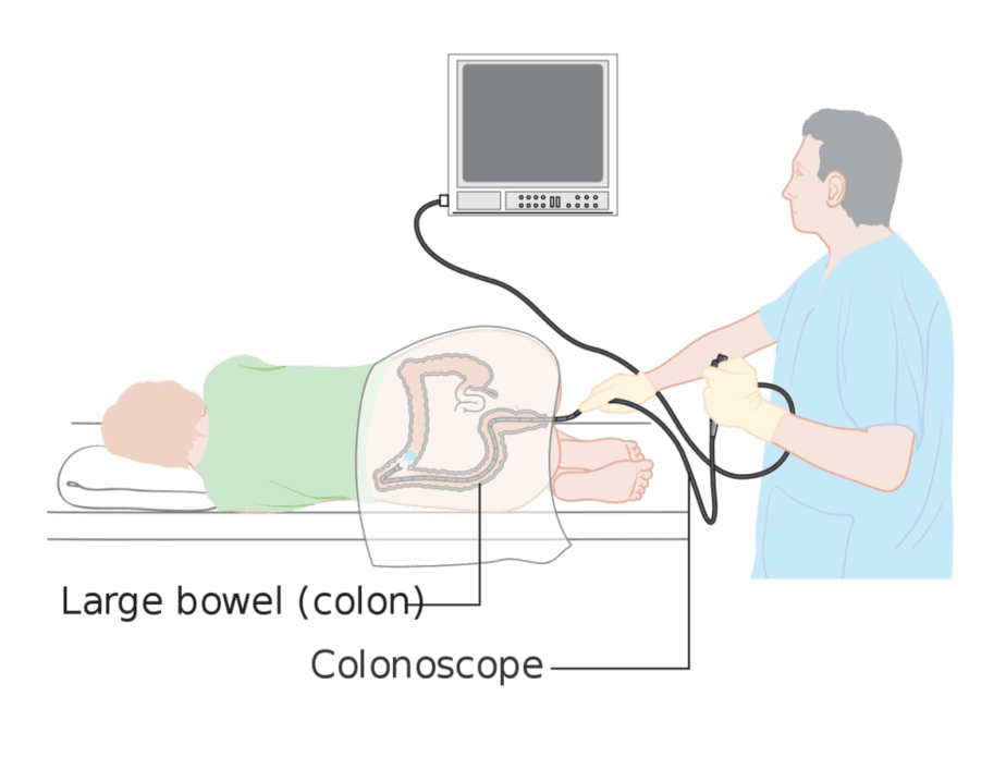 A colonoscopy