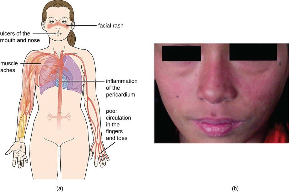 Signs and symptoms of lupus including internal and external symptoms