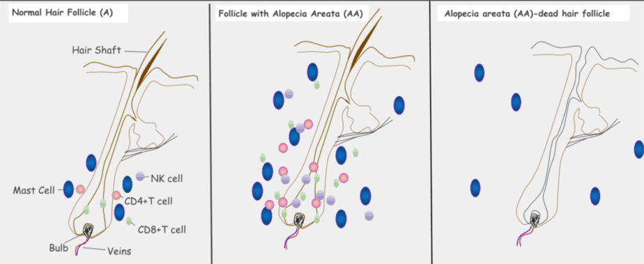 A hair follicule with alopecia areata