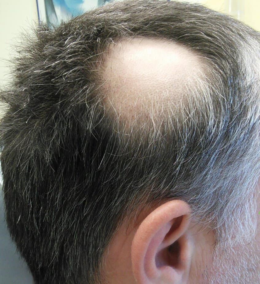 Bald patches are a common symptom of alopecia areata