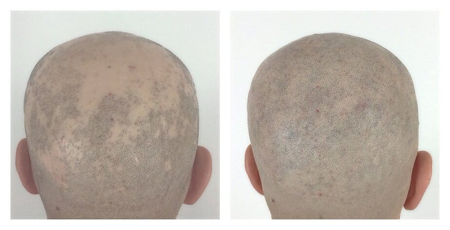 A type of balding pattern that can occur