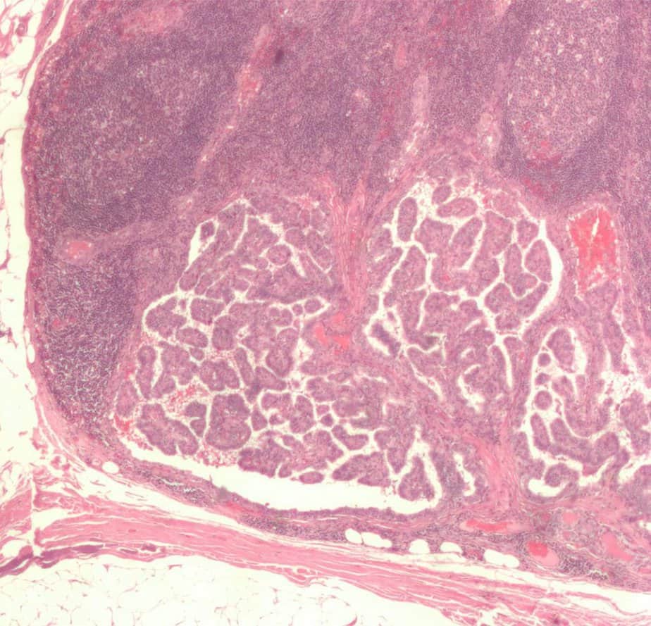 A tissue sample of papillary thyroid cancer