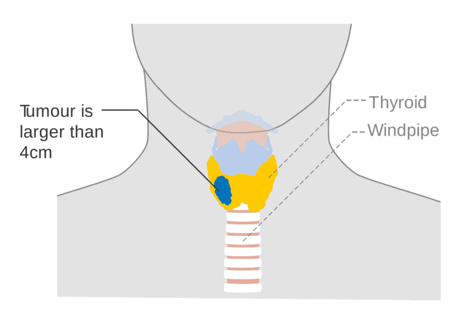 Diagram showing stage T3 thyroid cancer. 