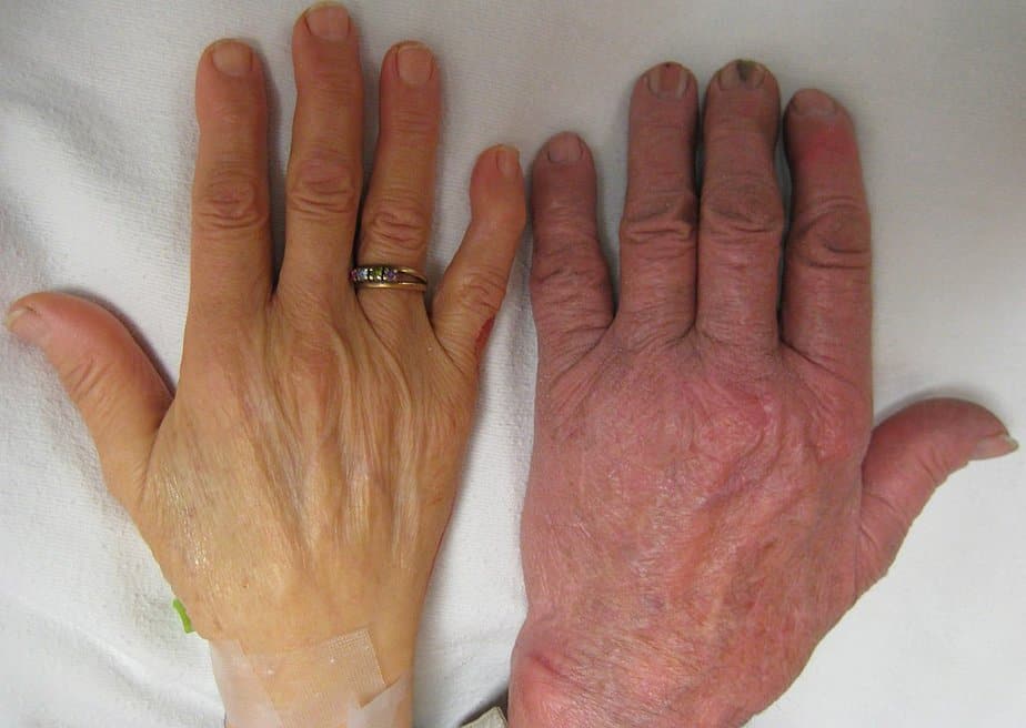 Swelling of the hands