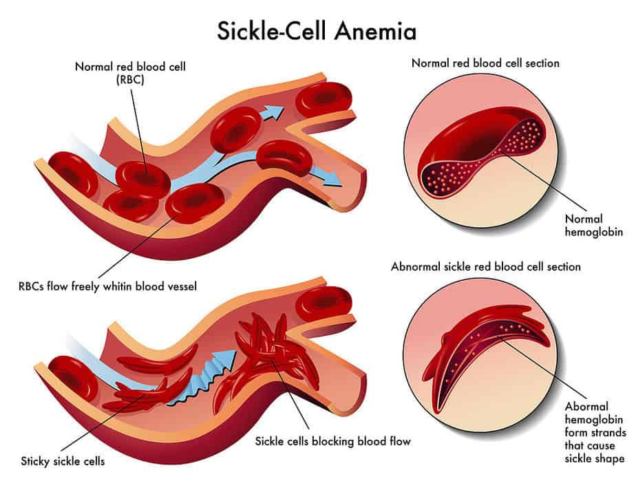 Sickle cell anemia