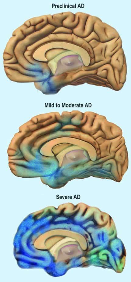 Alzheimer's progression