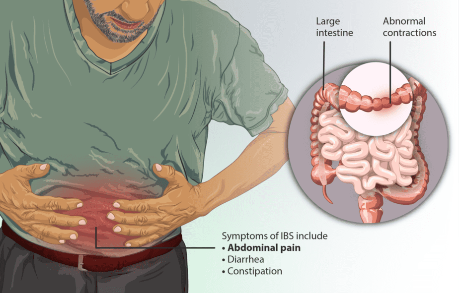 IBS symptoms