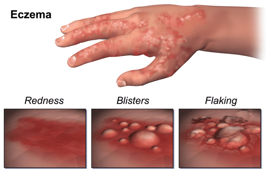 Redness, blisters, and flaking