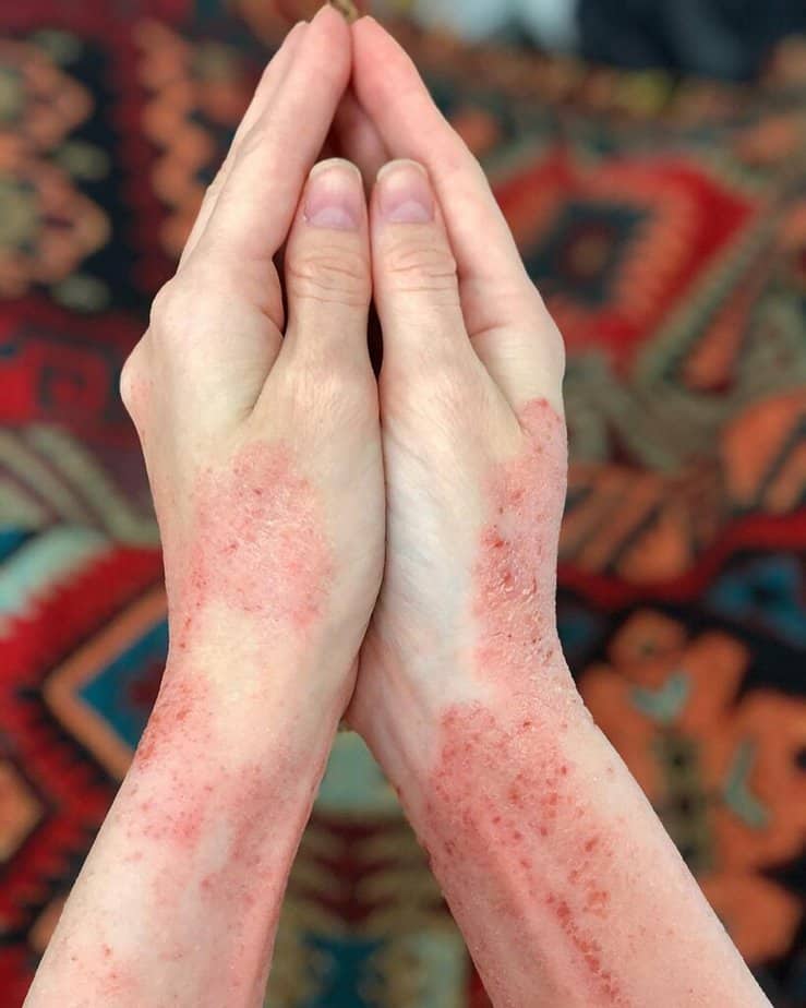 Eczema on the arms, wrists, and hands