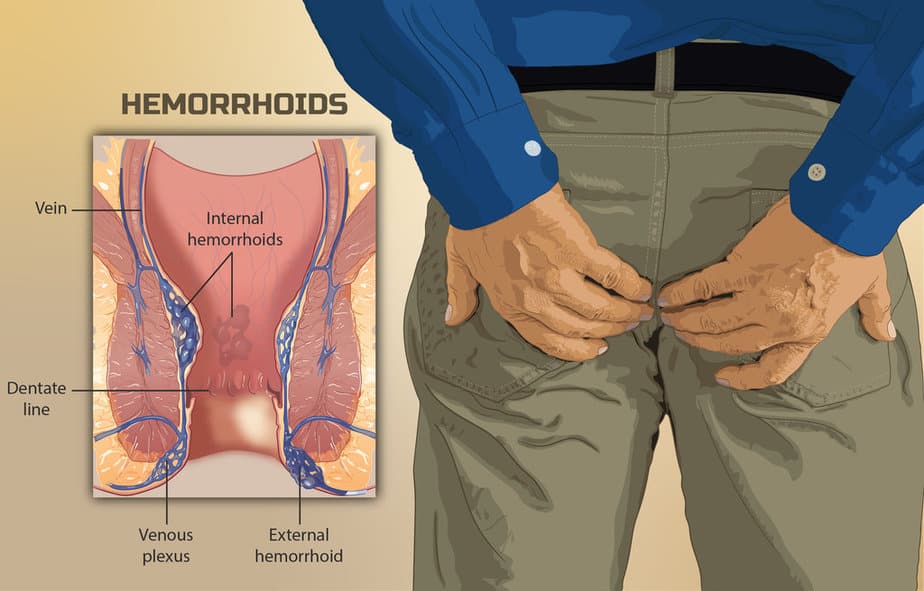 Hemorrhoid types