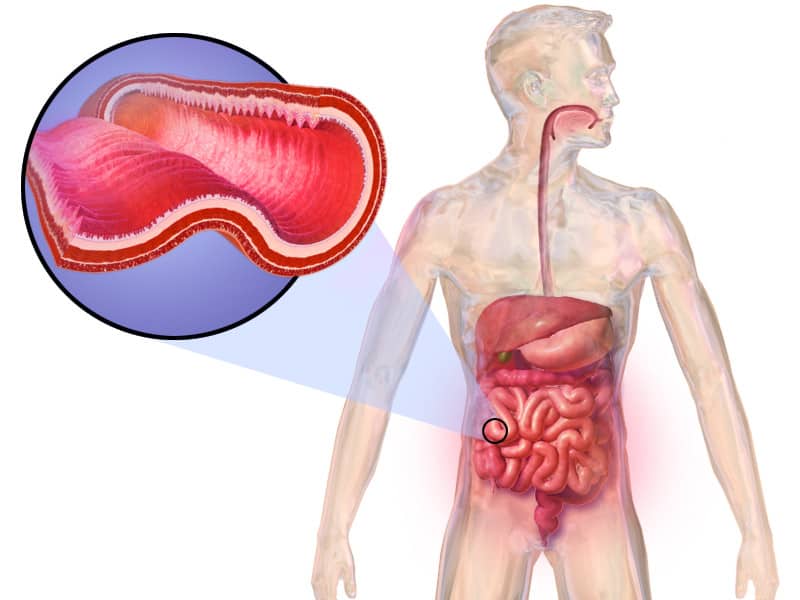 Crohn's disease in the digestive tract