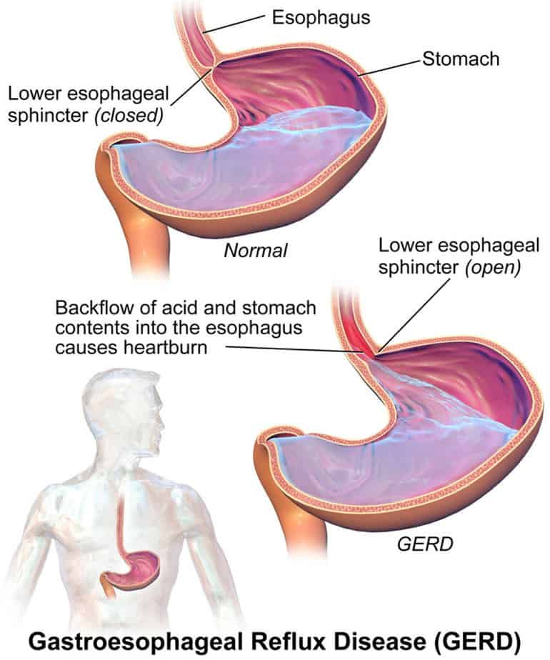 How GERD occurs