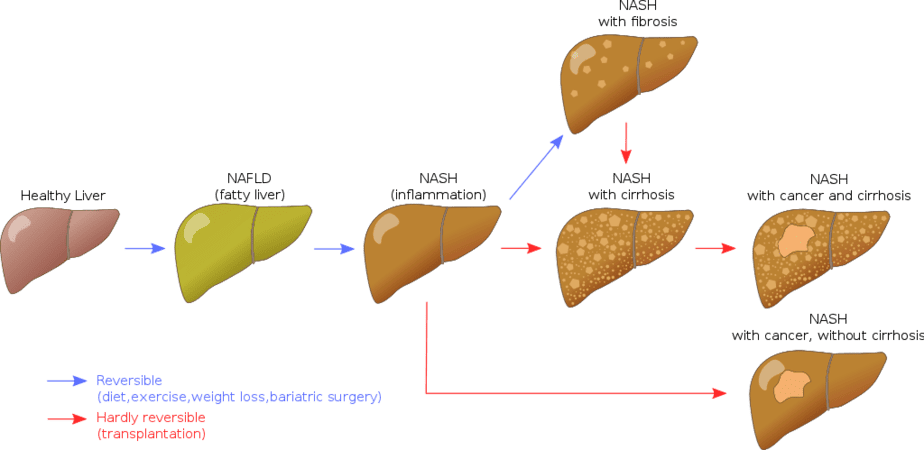 NAFLD liver progression