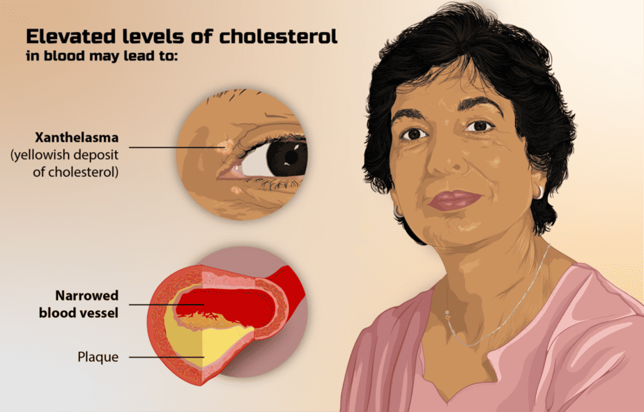 Signs of high cholesterol levels