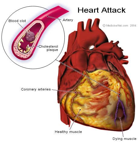 A blood clot and heart attack