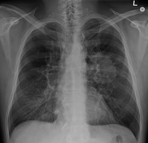 X-ray of chest 