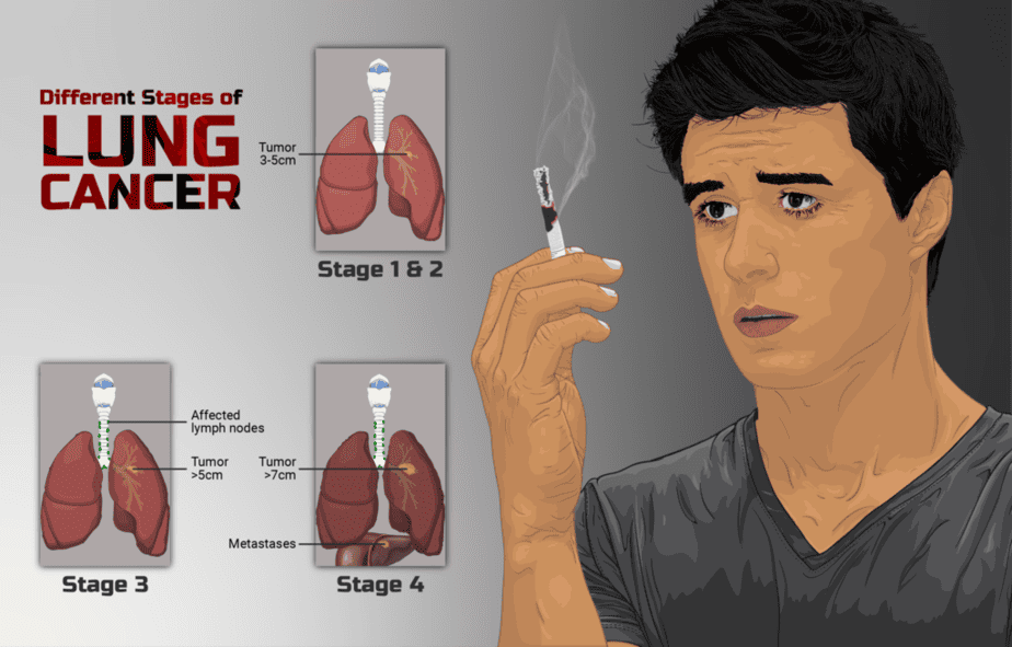 Stages of the disease