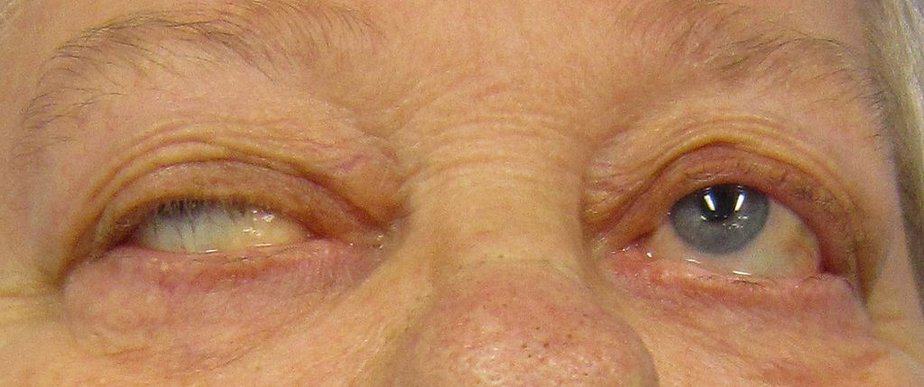 Symptoms of myasthenia gravis