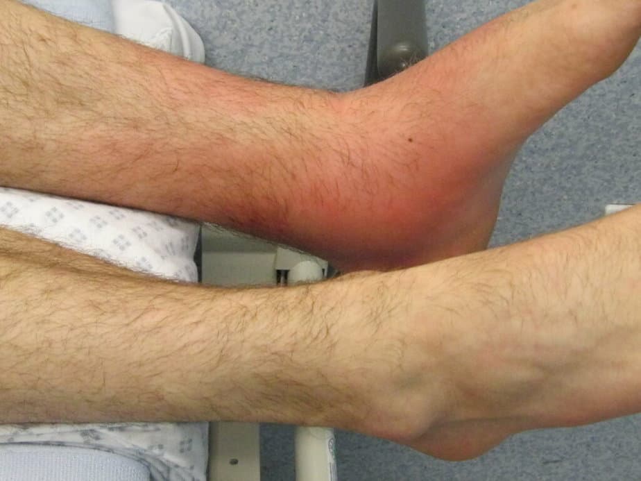 An ankle showing signs of inflammatory markers