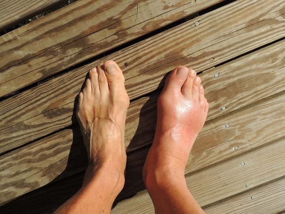 Gout in feet