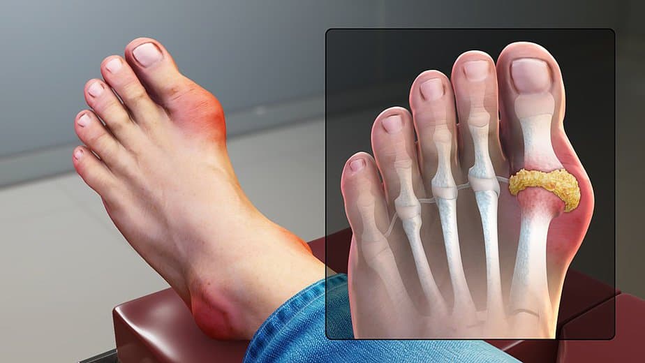 Gout symptoms