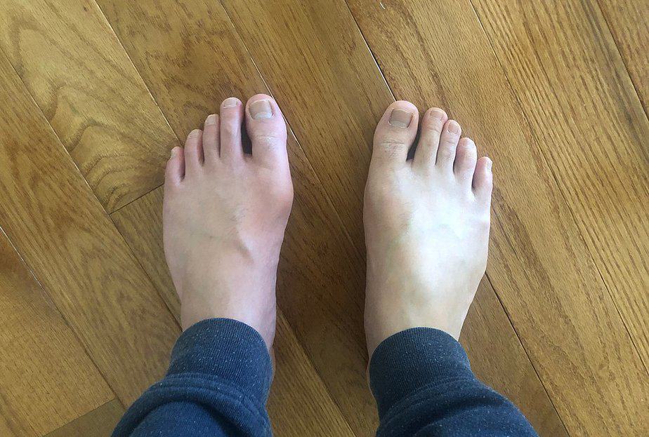 Gout in the left foot compared with a healthy foot