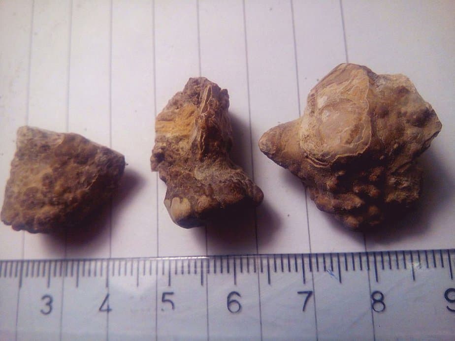 Various sizes of kidney stones.