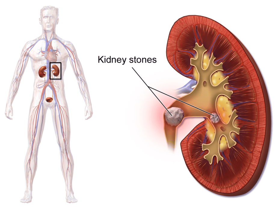 Location of kidney stones