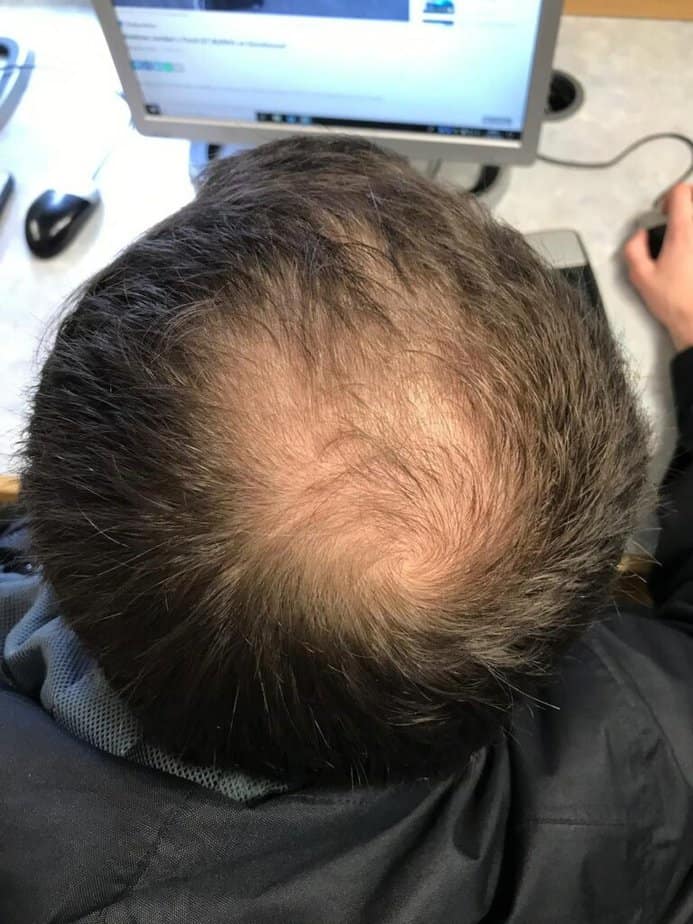 Keeps works to treat male pattern baldness