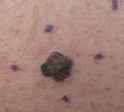 A mole that shows characteristics of melanoma