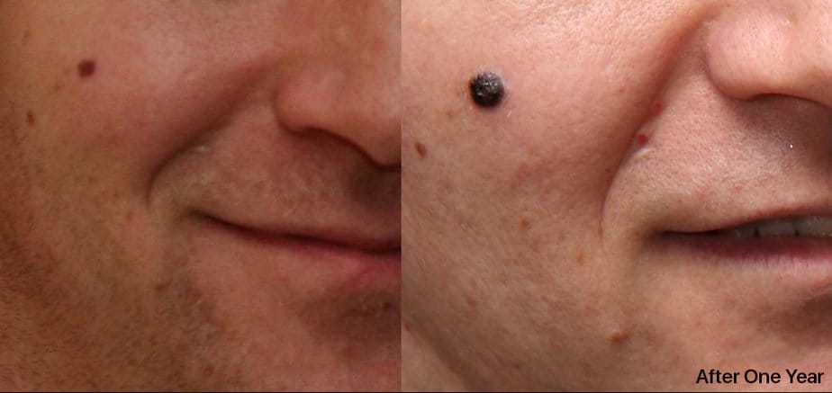 Melanoma on the face