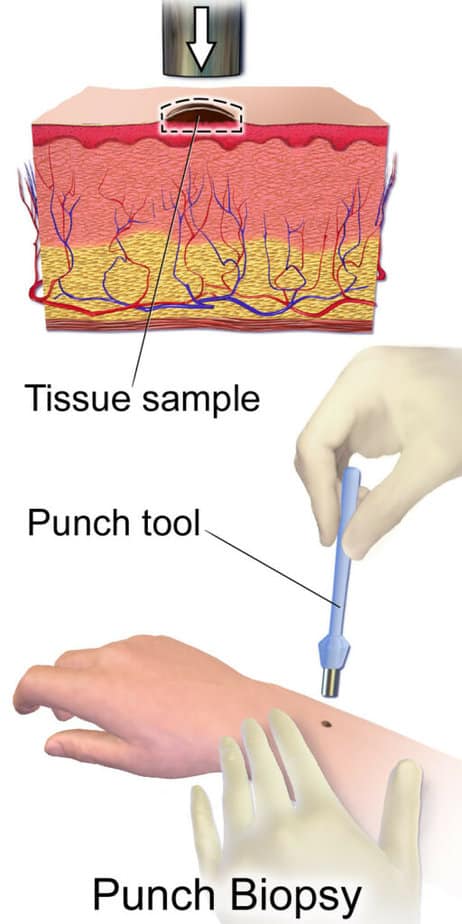 A punch biopsy procedure