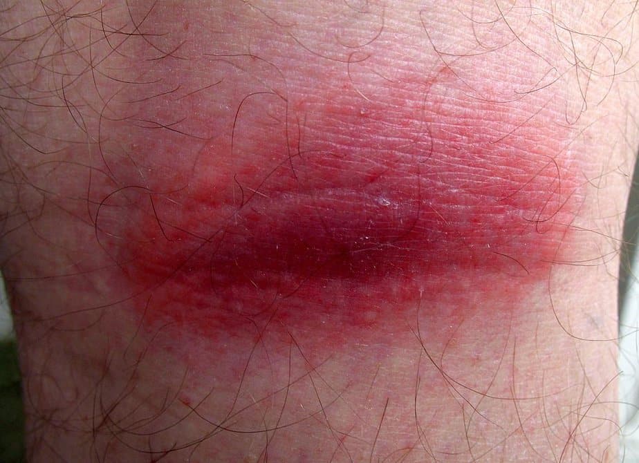 A localized case of inflammation
