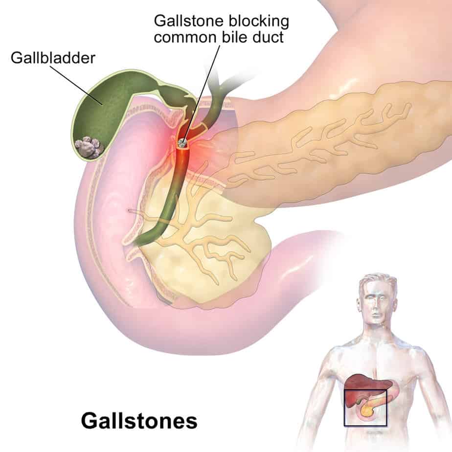 Gallstone blockage