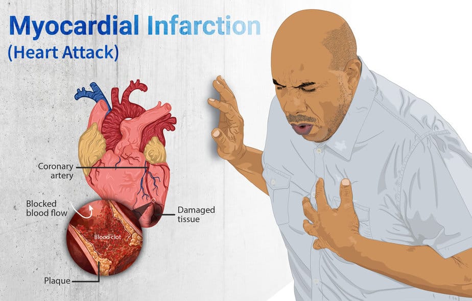 Depiction of a heart attack.