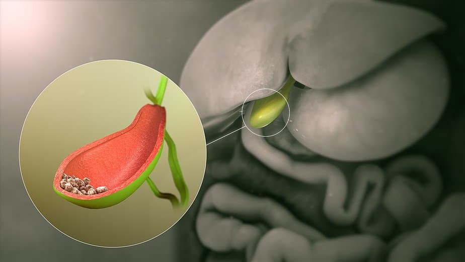 Gallbladder stones