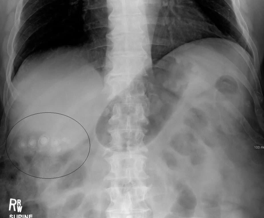 Gallstones on x-ray