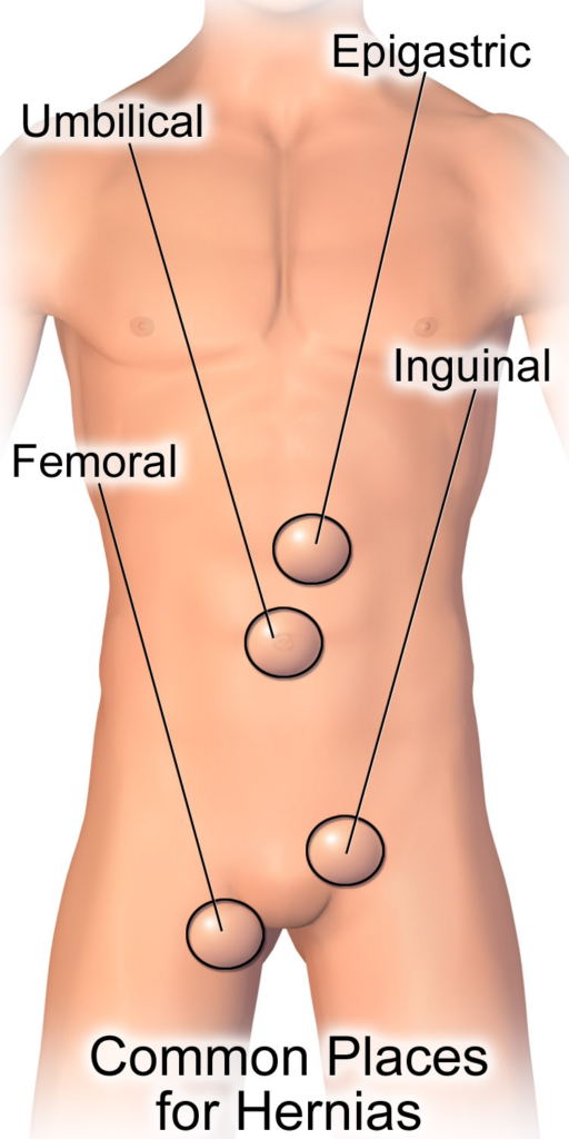 Common hernia locations