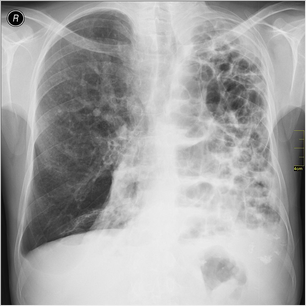 Chest x-ray diagnosis