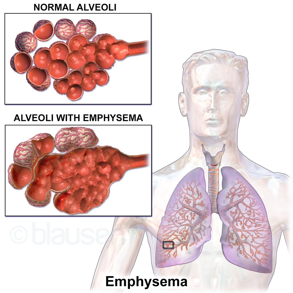 Depiction of emphysema