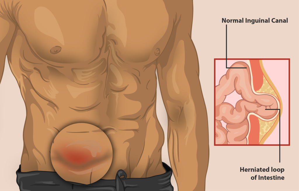 A man with an inguinal hernia