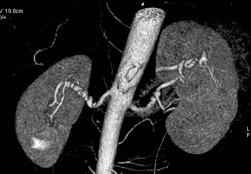 CT scan of fibromuscular dysplasia