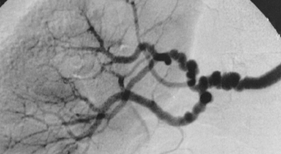 Multifocal fibromuscular dysplasia