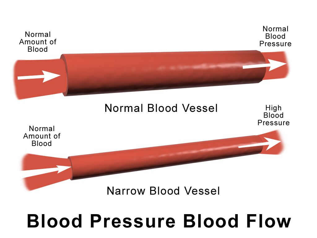 Illustration of high blood pressure